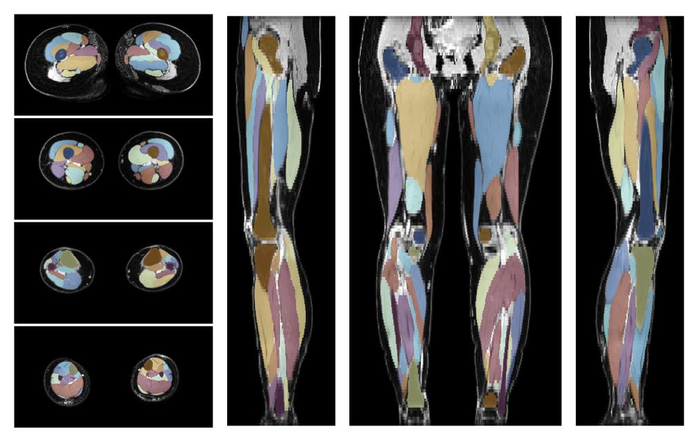 Overlay of automated muscle segmentation labels on dixon water image.